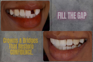 How Crowns & Bridges Restore Your Smile and Confidence