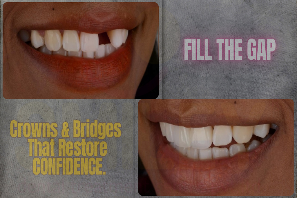 How Crowns & Bridges Restore Your Smile and Confidence
