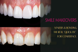 Veneers & Bonding for Chipped or Uneven Teeth